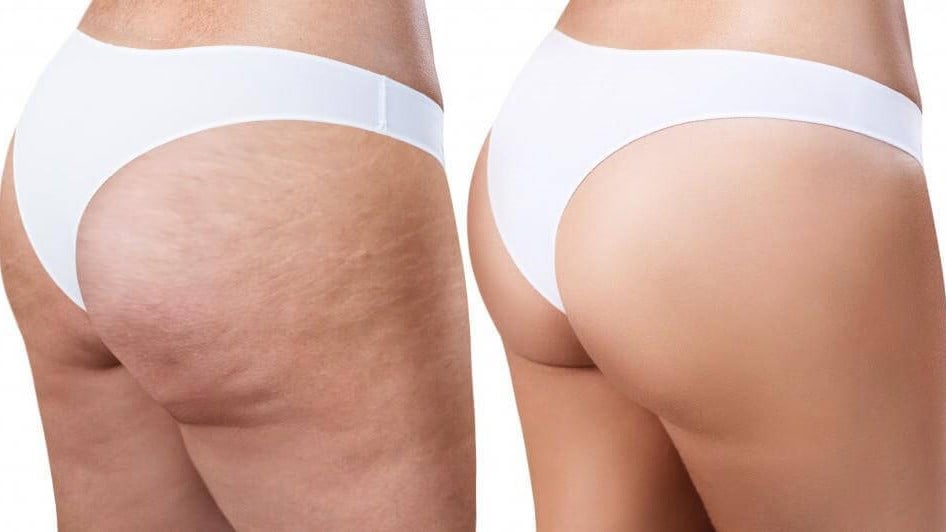 Here's How You Can Actually Get Rid of Cellulite