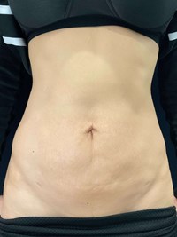 SKIN TIGHTENING BEFORE & AFTER PHOTOS